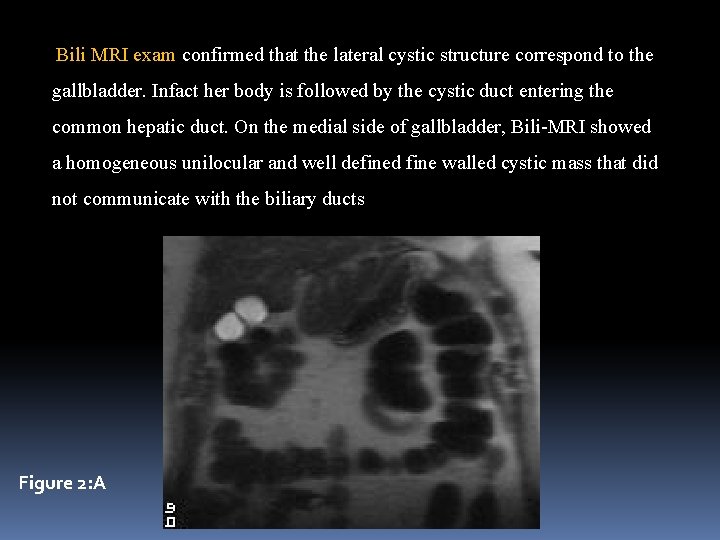 Bili MRI exam confirmed that the lateral cystic structure correspond to the gallbladder. Infact