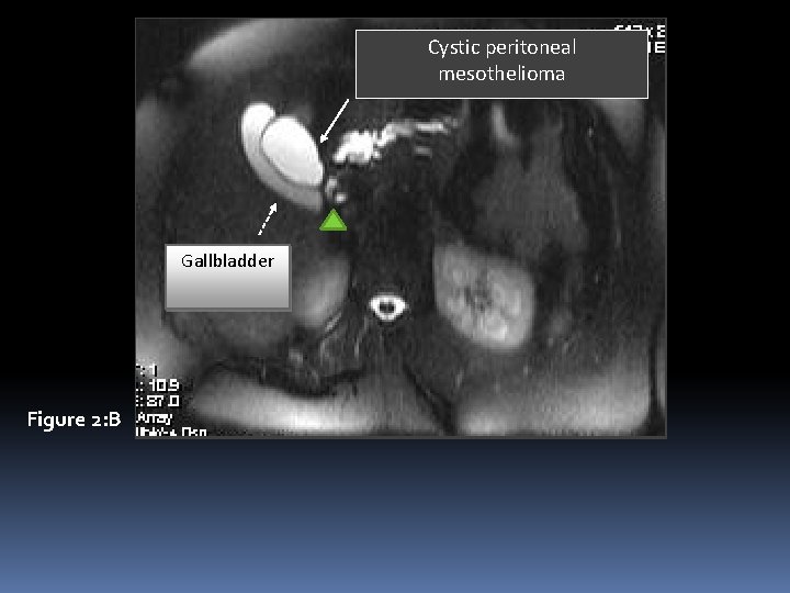 Cystic peritoneal mesothelioma Gallbladder Figure 2: B 