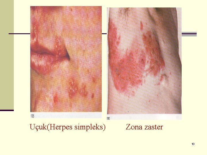 Uçuk(Herpes simpleks) Zona zaster 10 