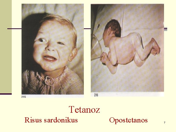 Tetanoz Risus sardonikus Opostetanos 7 