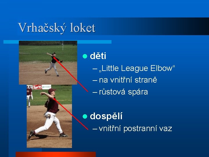 Vrhačský loket l děti – „Little League Elbow“ – na vnitřní straně – růstová