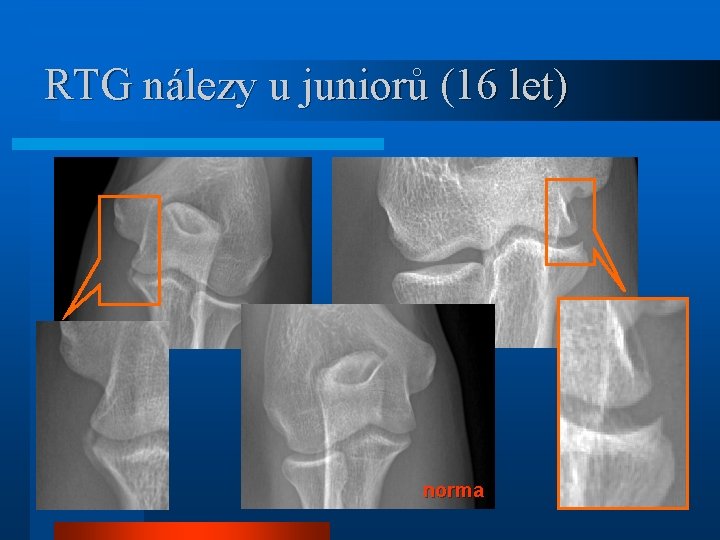 RTG nálezy u juniorů (16 let) norma 