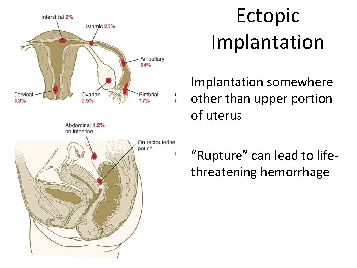 Ectopic Implantation somewhere other than upper portion of uterus “Rupture” can lead to lifethreatening