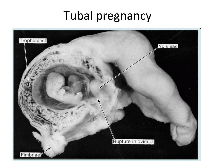 Tubal pregnancy 