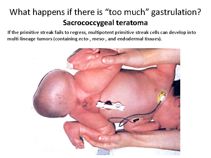 What happens if there is “too much” gastrulation? Sacrococcygeal teratoma If the primitive streak