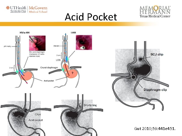 Acid Pocket Gut 2010; 59: 441 e 451. 