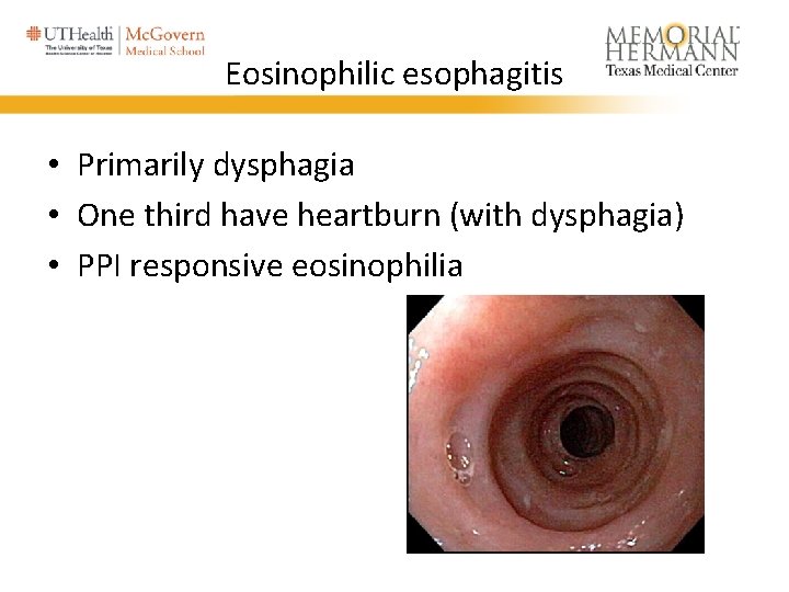 Eosinophilic esophagitis • Primarily dysphagia • One third have heartburn (with dysphagia) • PPI