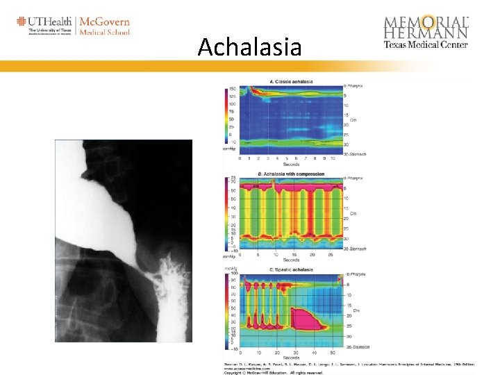 Achalasia 