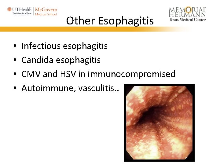 Other Esophagitis • • Infectious esophagitis Candida esophagitis CMV and HSV in immunocompromised Autoimmune,