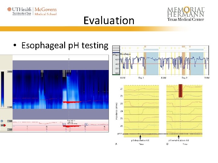 Evaluation • Esophageal p. H testing 