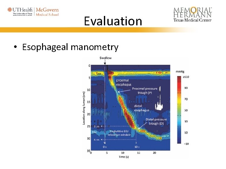 Evaluation • Esophageal manometry 