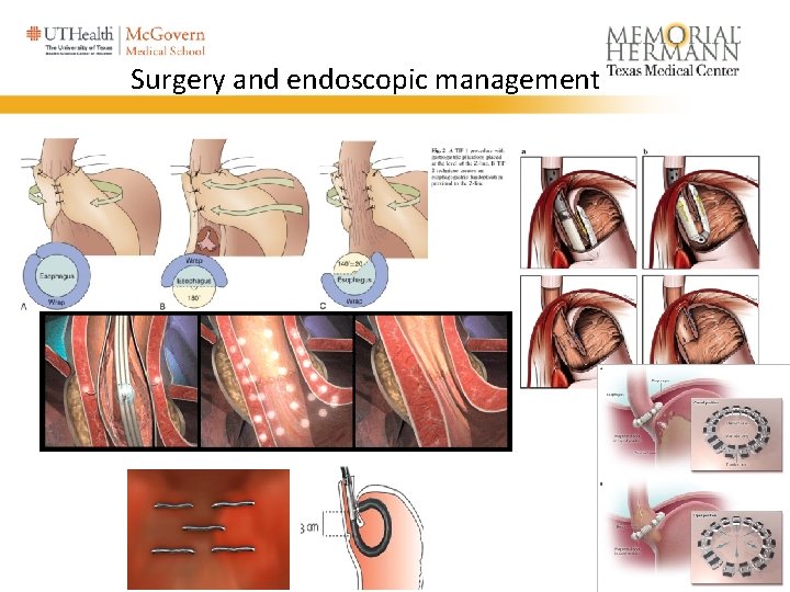 Surgery and endoscopic management 