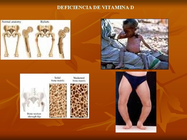 DEFICIENCIA DE VITAMINA D 