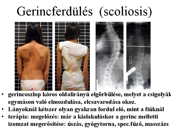 Gerincferdülés (scoliosis) • gerincoszlop kóros oldalirányú elgörbülése, melyet a csigolyák egymáson való elmozdulása, elcsavarodása