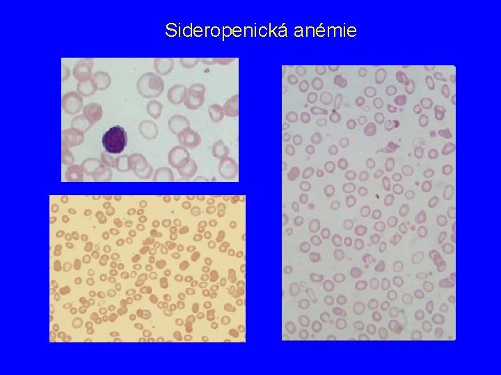 Sideropenická anémie 