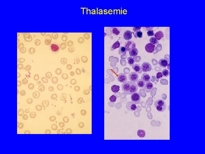 Thalasemie 