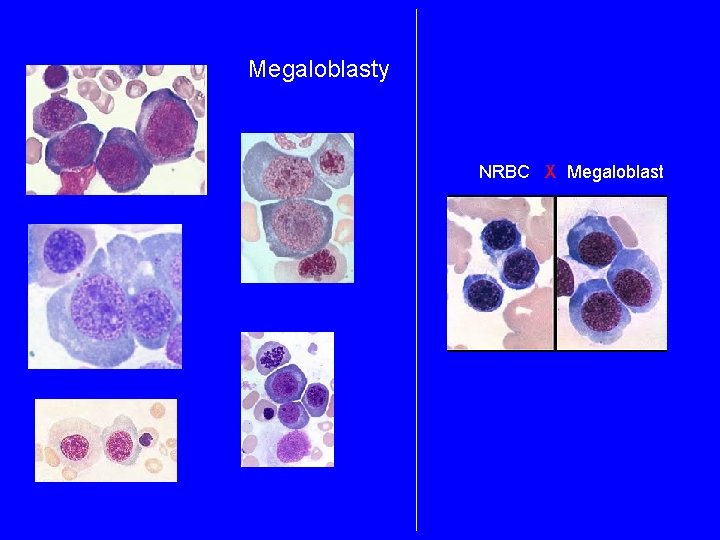 Megaloblasty NRBC X Megaloblast 