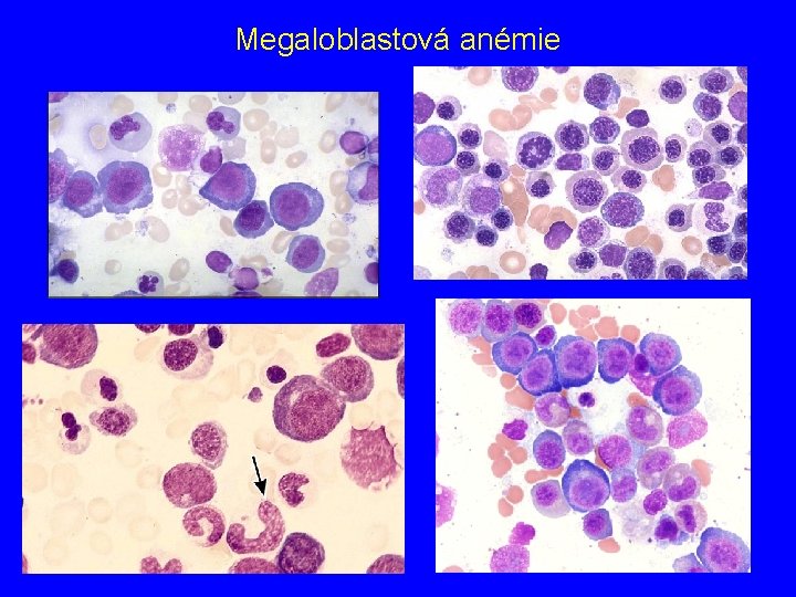 Megaloblastová anémie 