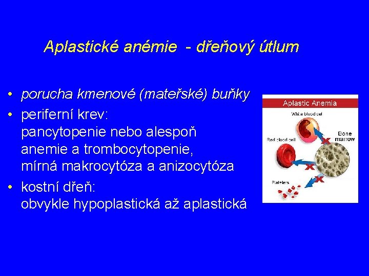 Aplastické anémie - dřeňový útlum • porucha kmenové (mateřské) buňky • periferní krev: pancytopenie