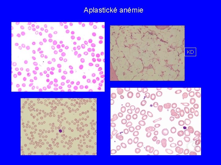 Aplastické anémie KD 
