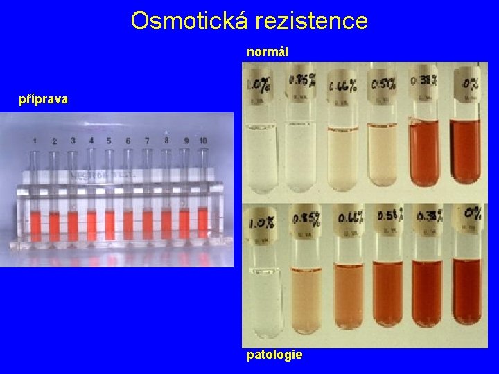 Osmotická rezistence normál příprava patologie 
