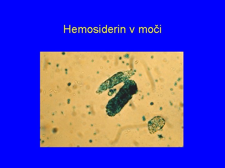 Hemosiderin v moči 