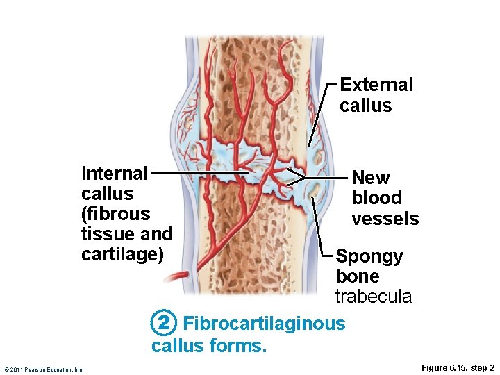 External callus Internal callus (fibrous tissue and cartilage) New blood vessels Spongy bone trabecula