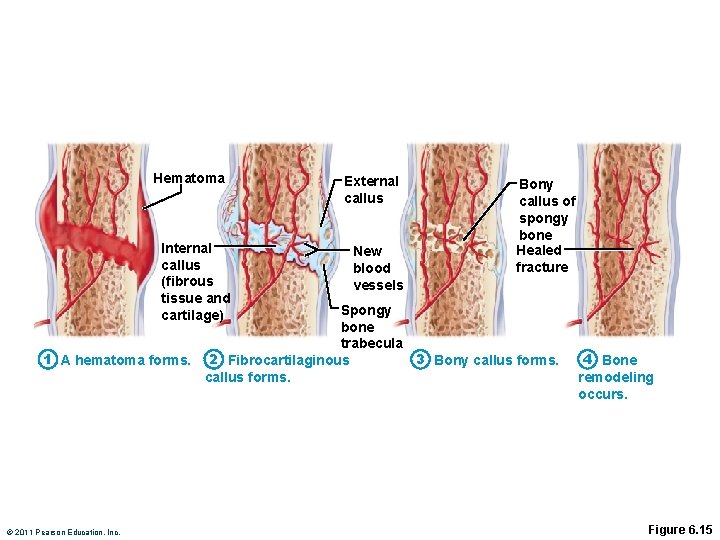 Hematoma Internal callus (fibrous tissue and cartilage) External callus New blood vessels Bony callus