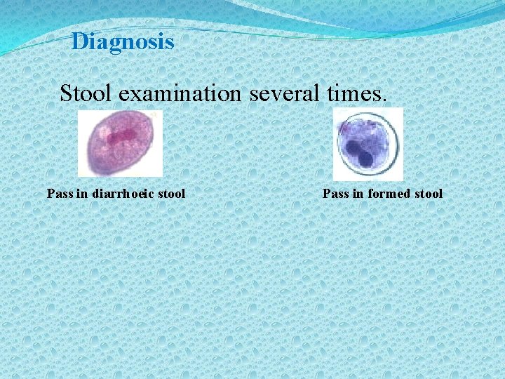 Diagnosis Stool examination several times. Pass in diarrhoeic stool Pass in formed stool 