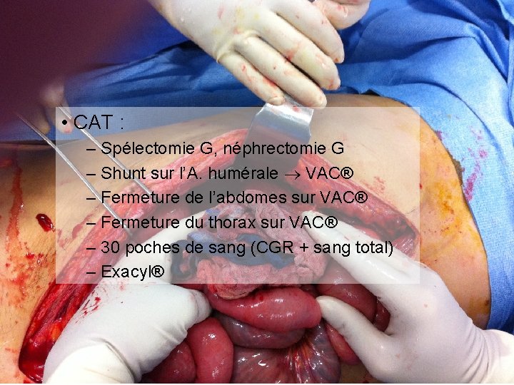  • CAT : – Spélectomie G, néphrectomie G – Shunt sur l’A. humérale