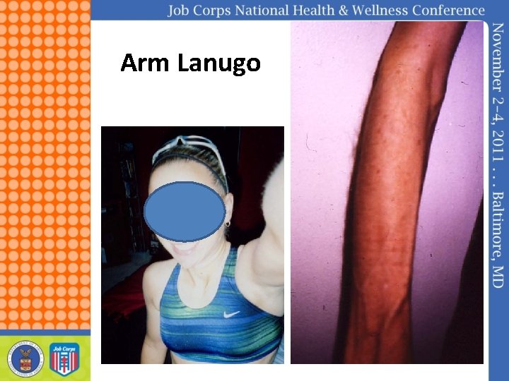 Arm Lanugo 
