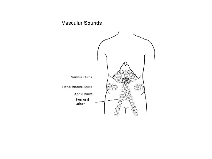 Vascular Sounds Femoral artery 