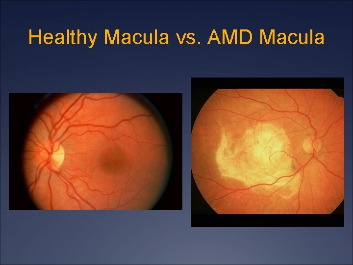 Healthy Macula vs. AMD Macula 