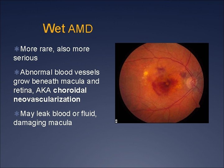 Wet AMD ✱More rare, also more serious ✱Abnormal blood vessels grow beneath macula and