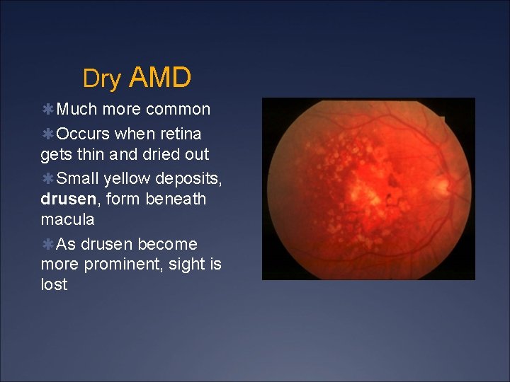 Dry AMD ✱Much more common ✱Occurs when retina gets thin and dried out ✱Small