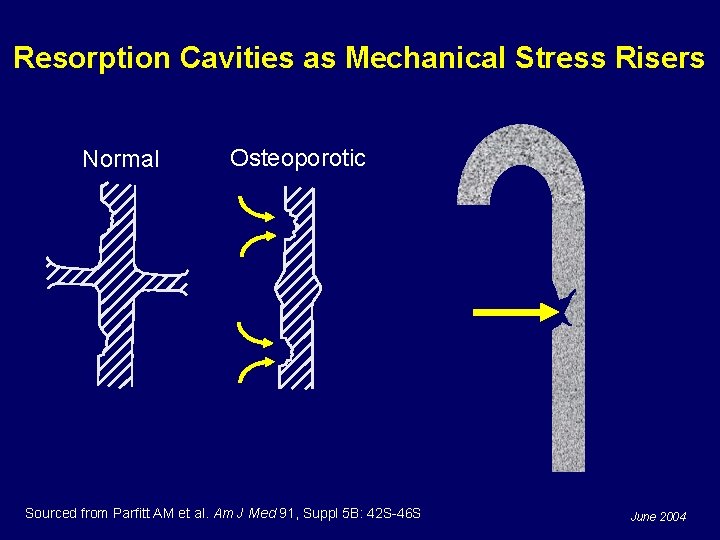 Resorption Cavities as Mechanical Stress Risers Normal Osteoporotic Sourced from Parfitt AM et al.