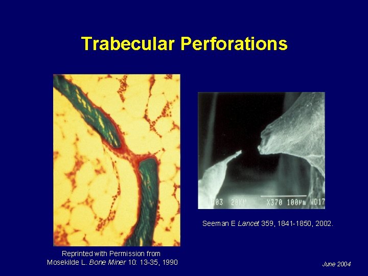 Trabecular Perforations Seeman E Lancet 359, 1841 -1850, 2002. Reprinted with Permission from Mosekilde