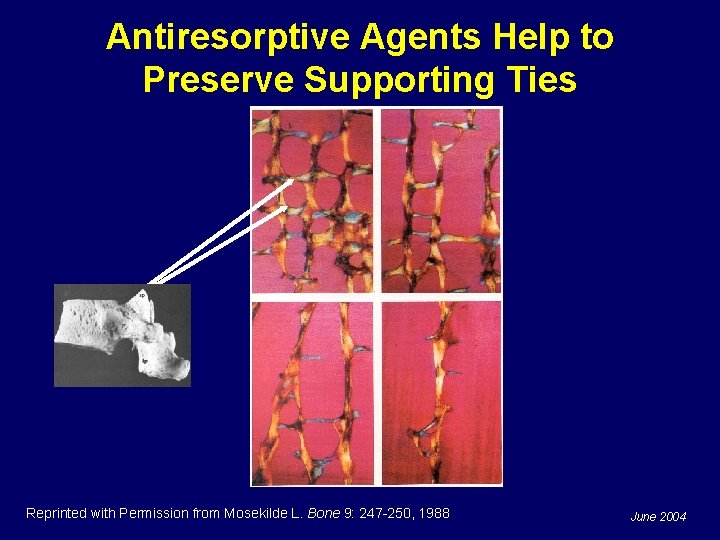 Antiresorptive Agents Help to Preserve Supporting Ties Reprinted with Permission from Mosekilde L. Bone
