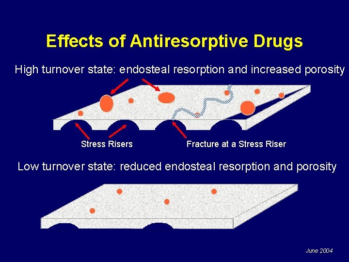 Effects of Antiresorptive Drugs High turnover state: endosteal resorption and increased porosity Stress Risers