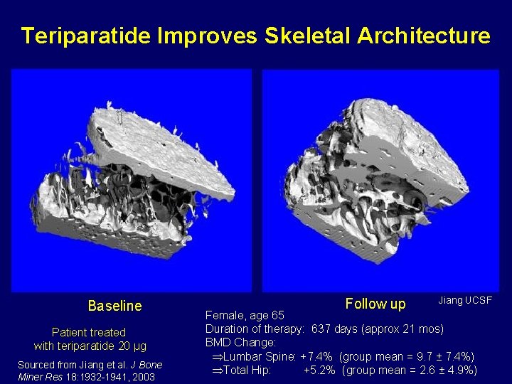 Teriparatide Improves Skeletal Architecture Baseline Patient treated with teriparatide 20 µg Sourced from Jiang
