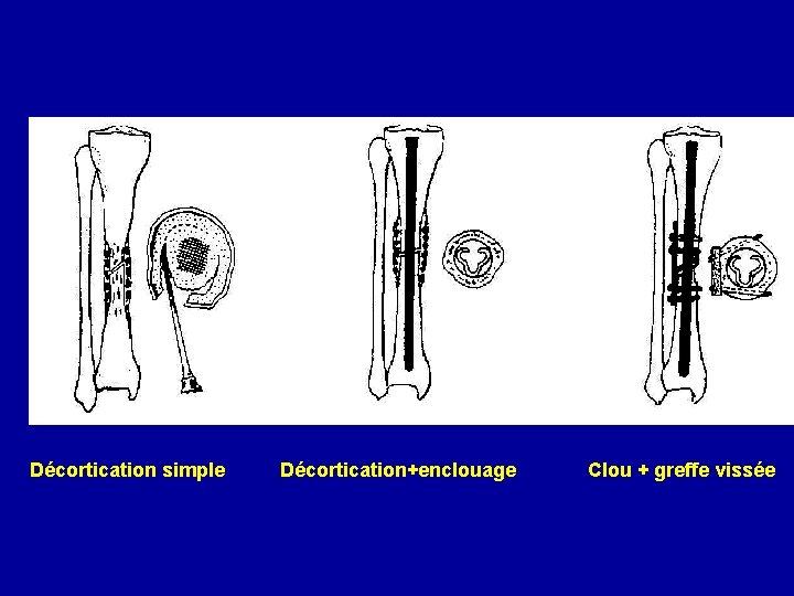 Décortication simple Décortication+enclouage Clou + greffe vissée 