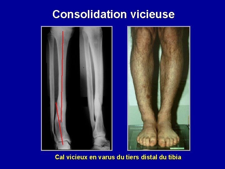 Consolidation vicieuse Cal vicieux en varus du tiers distal du tibia 