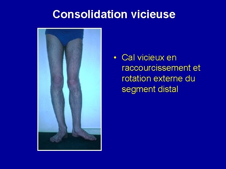 Consolidation vicieuse • Cal vicieux en raccourcissement et rotation externe du segment distal 