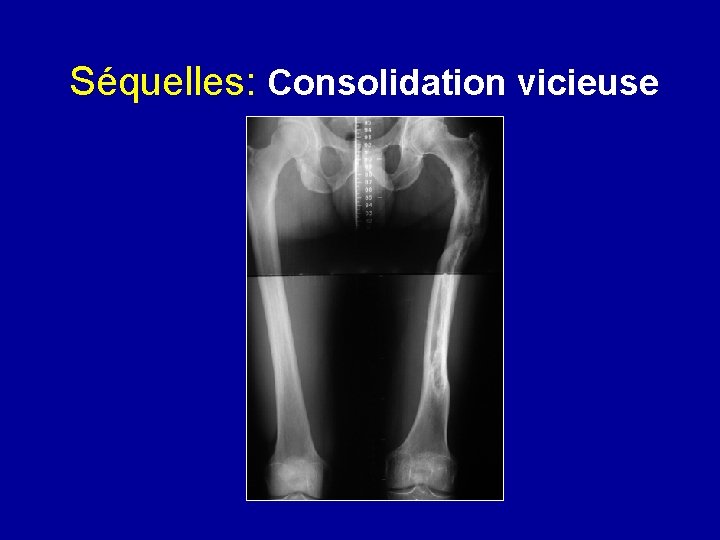 Séquelles: Consolidation vicieuse 