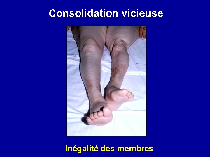 Consolidation vicieuse Inégalité des membres 