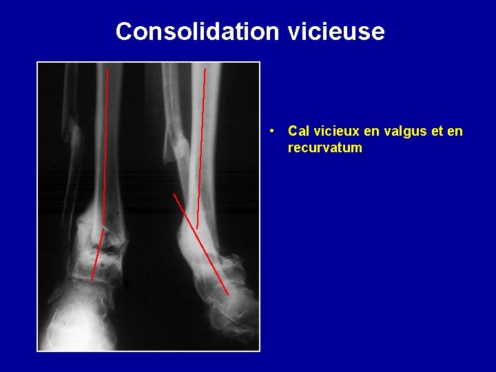 Consolidation vicieuse • Cal vicieux en valgus et en recurvatum 