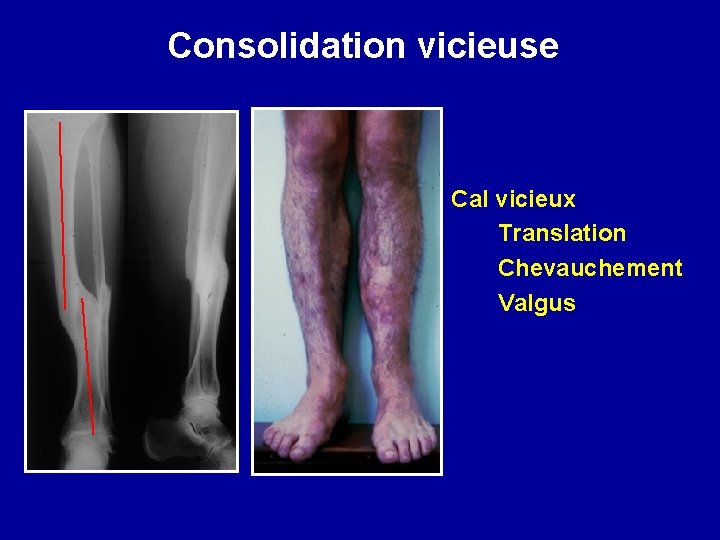 Consolidation vicieuse Cal vicieux Translation Chevauchement Valgus 