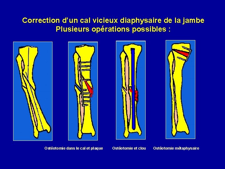 Correction d’un cal vicieux diaphysaire de la jambe Plusieurs opérations possibles : Ostéotomie dans