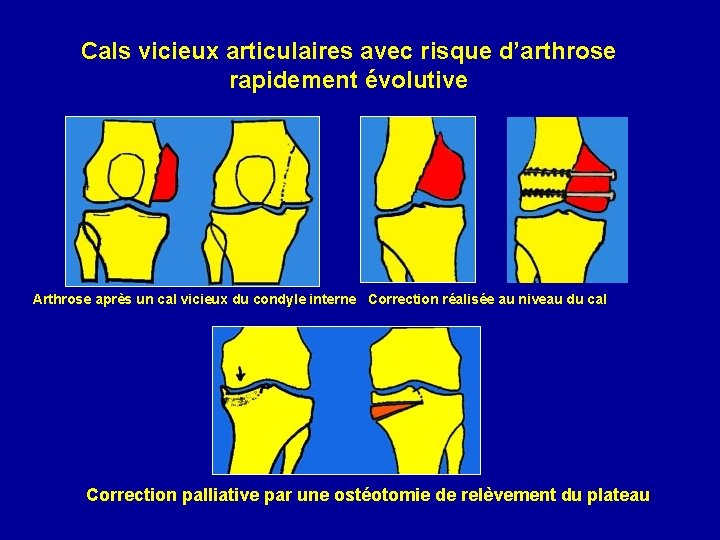 Cals vicieux articulaires avec risque d’arthrose rapidement évolutive Arthrose après un cal vicieux du