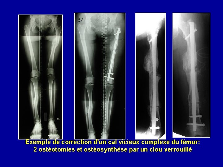 Exemple de correction d’un cal vicieux complexe du fémur: 2 ostéotomies et ostéosynthèse par